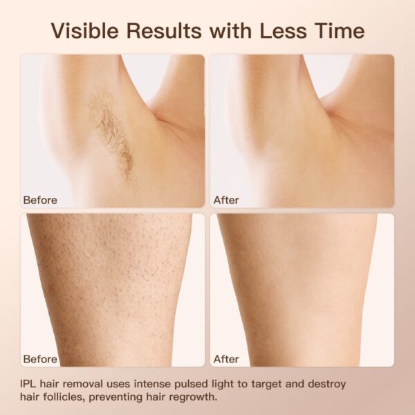 Electric Laser Hair Removal Device