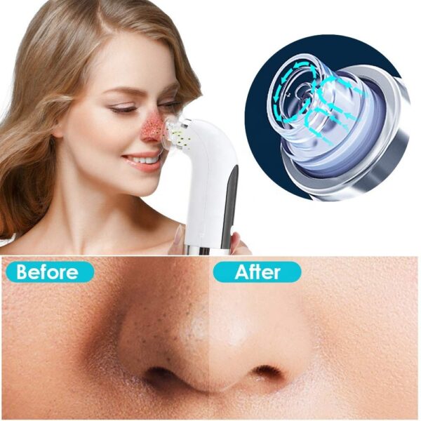 Blackhead Cleanser
