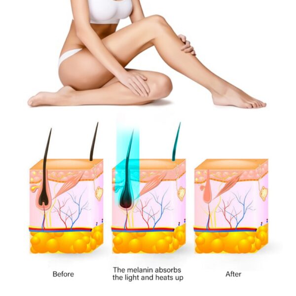 Handset Ipl Hair Removal