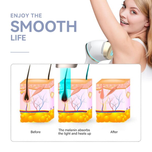 IPL Epilator Dealers